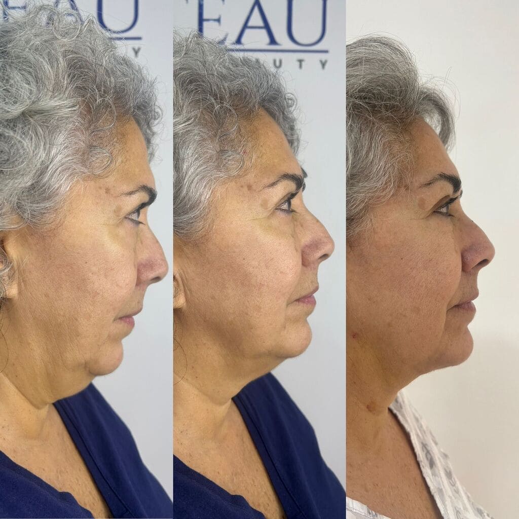 ANTES Y DESPUÉS M.E.L.A