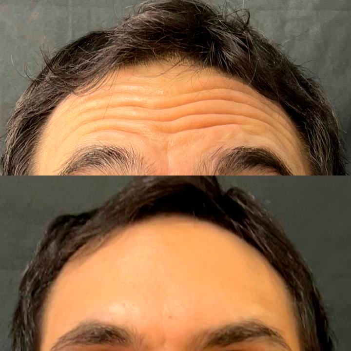 botox