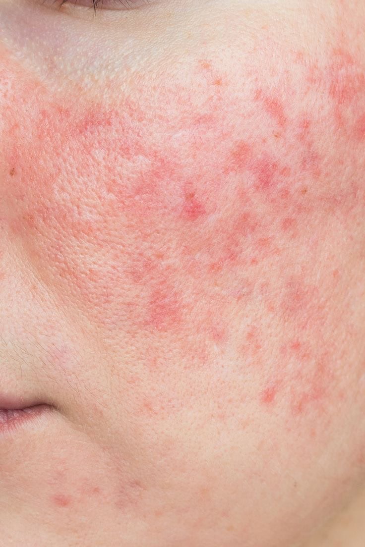 ROSACEA (1)