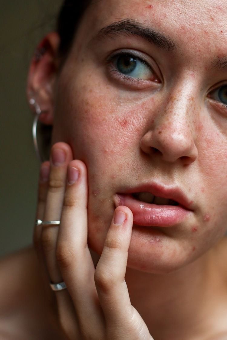 ROSACEA Y ACNE (1)